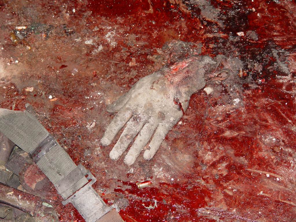Beslan. Severed arm