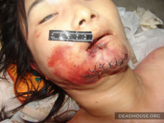 Синяки и травма подбородка на лице мертвой девушки