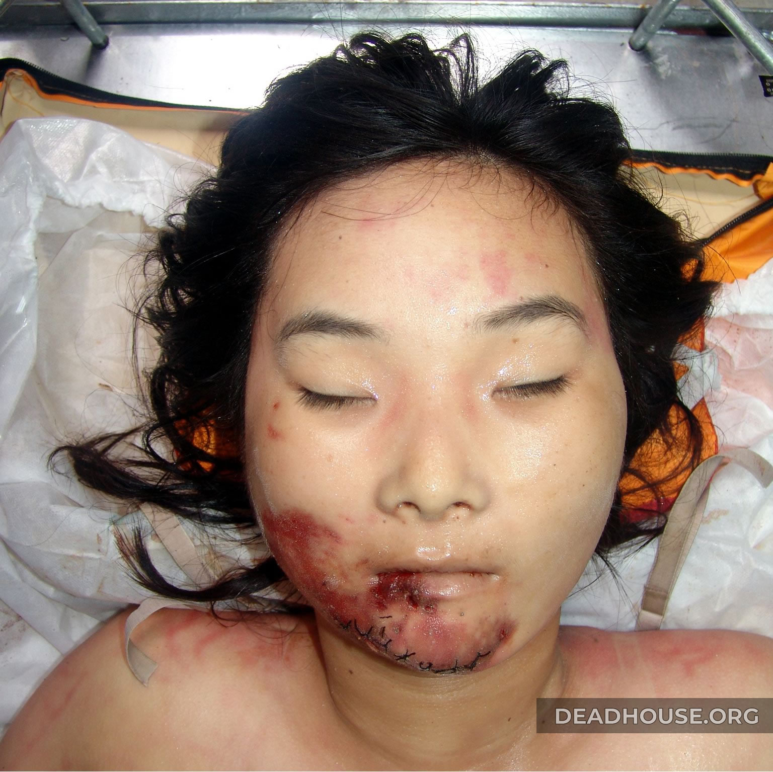 Dead beaten girl with bruises and broken teeth