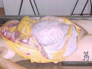 Вскрытие беременной женщины в морге