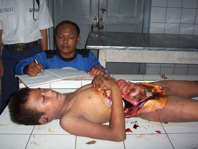 Child autopsy. Indonesia