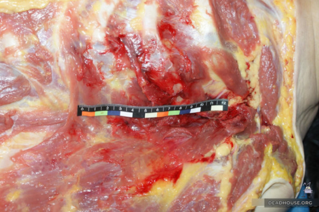 Кровоизлияние в области груди. Измерения
