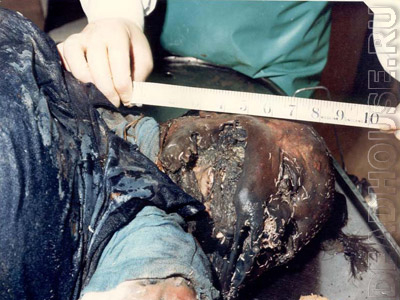 Разложившийся труп. Половина тела этой женщины пролежала в воде несколько месяцев