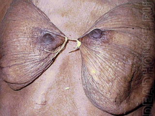 Труп женщины с перевязанной грудью