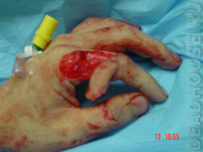 Травматическая ампутация пальца