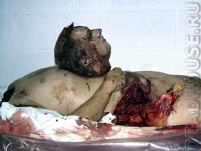 Criminal corpse in the morgue. The head of the corpse is separated from the body, the corpse is damaged.