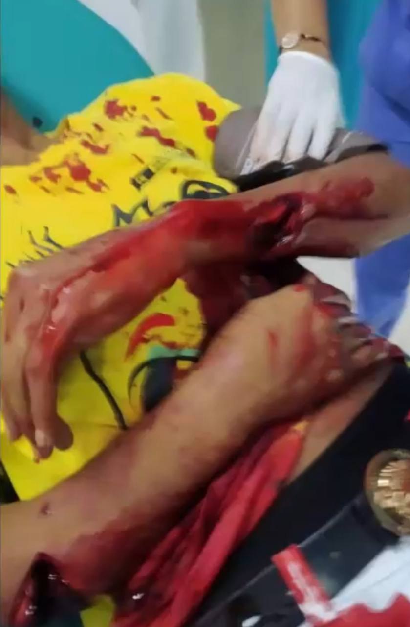Injury after attack with a machete