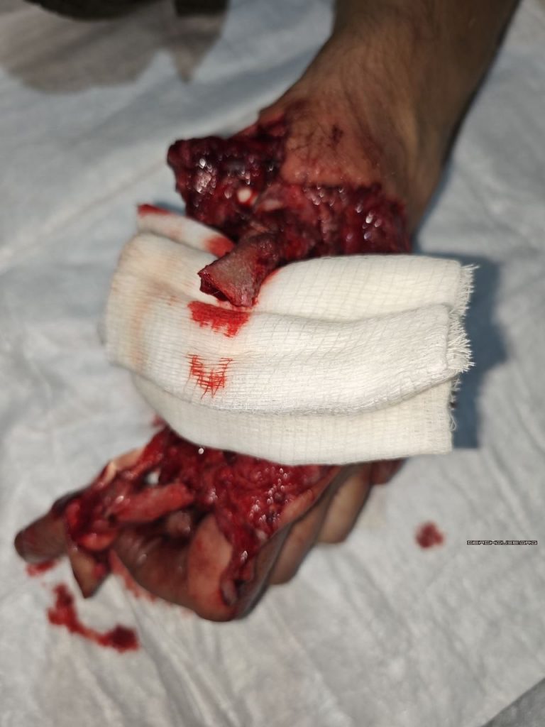 Treatment of a partially amputated hand