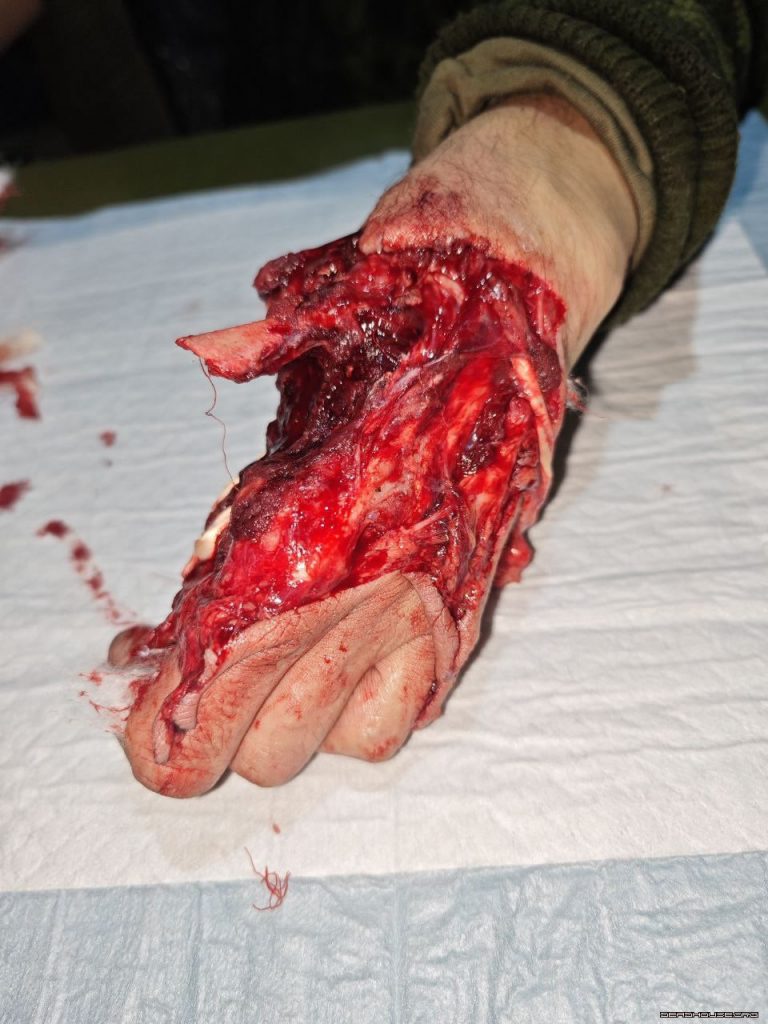 Treatment of a partially amputated hand