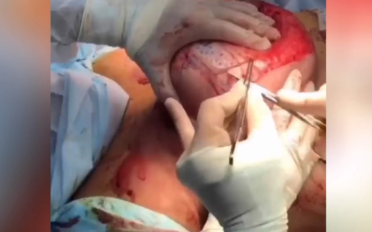 Reduction mammoplasty. Operation video