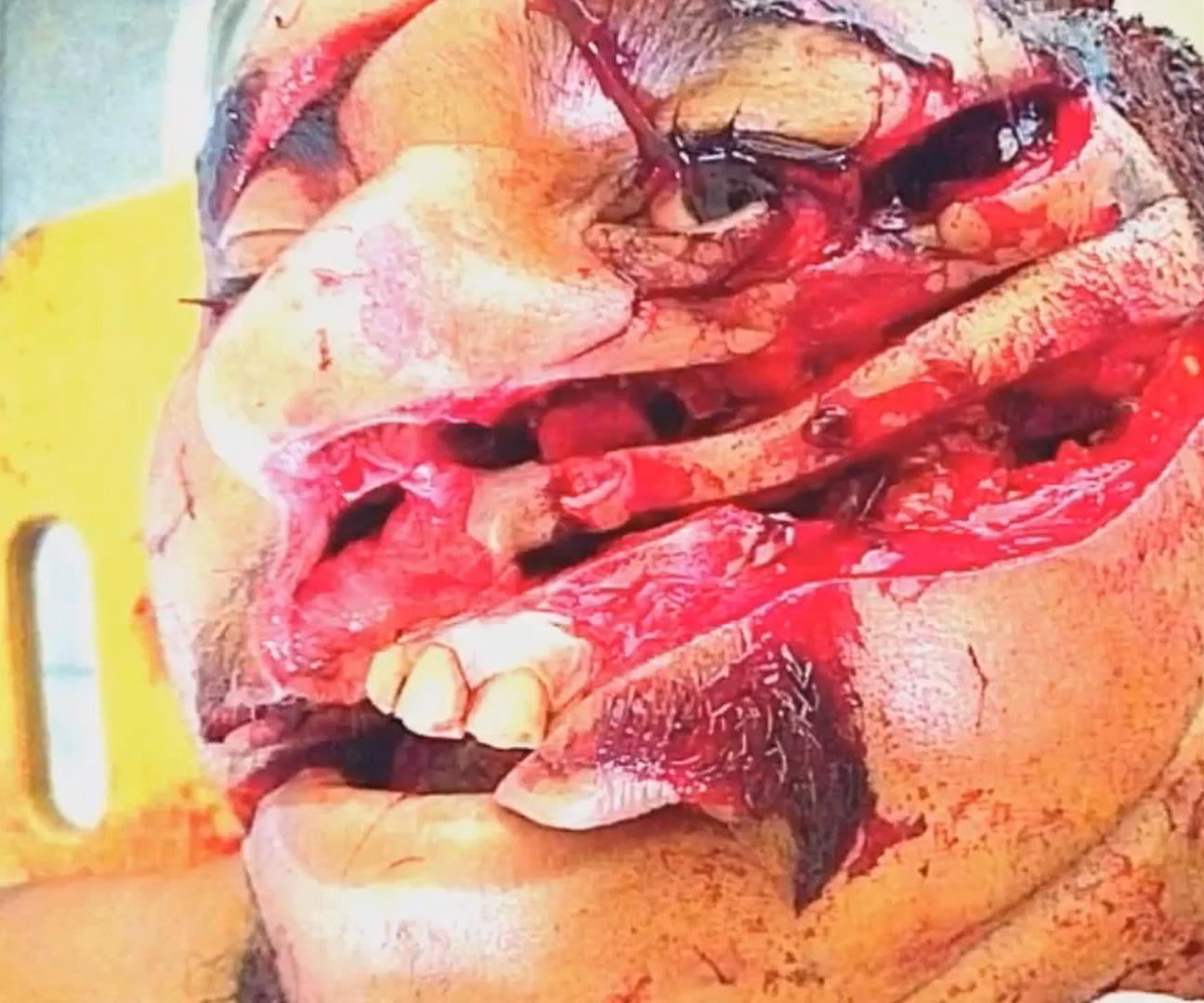 Machete marks on the victim's face