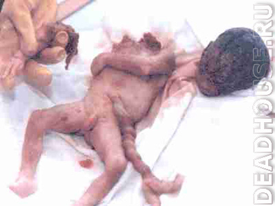 Человеческие эмбрионы. Результаты абортов