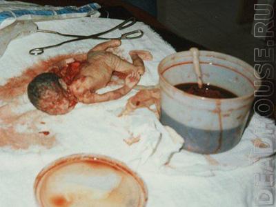 Человеческие эмбрионы. Результаты абортов