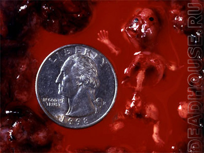Аборт. Результат аборта. 8 недель