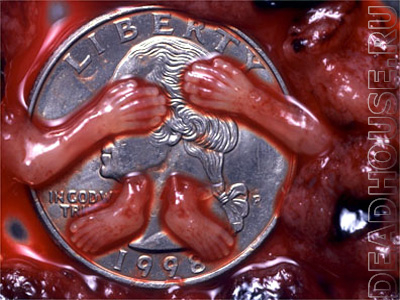 Результат аборта. 8 недель