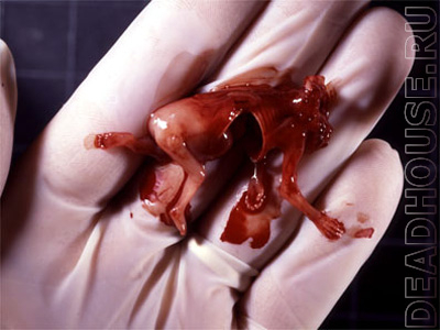 Аборт. Результат аборта. 11 недель