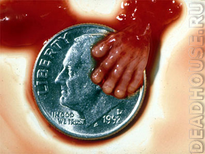 Результат аборта. 10 недель