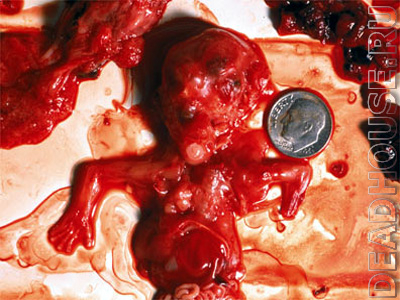 Результат аборта. 11 недель