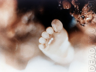 Аборт. Результат аборта. 13 недель