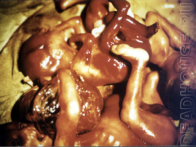 Результаты абортов. Человеческие эмбрионы