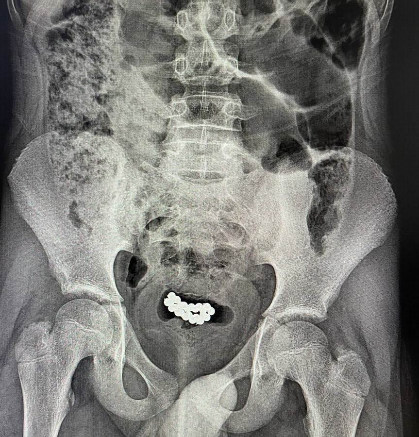 X-rays. Magnetic balloons in the bladder