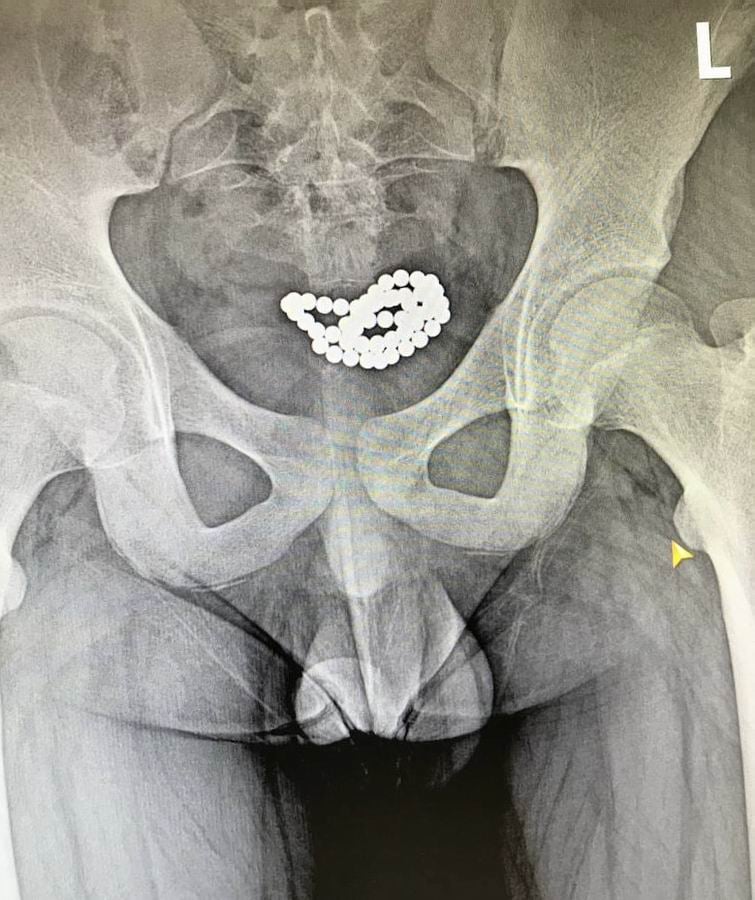 X-ray. Magnetic balls in the bladder